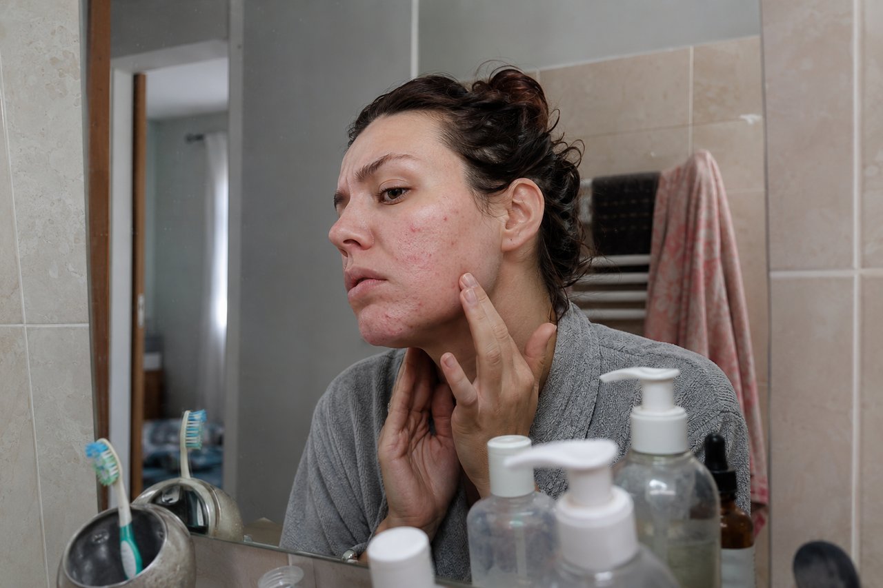 A woman examining acne breakouts and irritation on her cheek and jaw in a bathroom mirror
